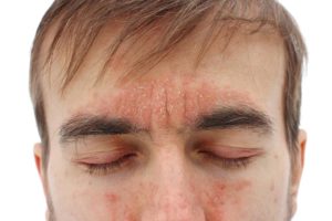 psoriasis in the face